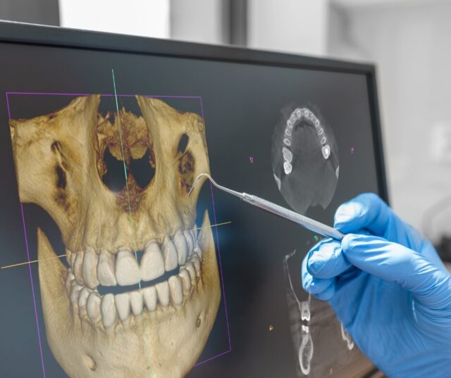 dawka promieniowania podczas cbct