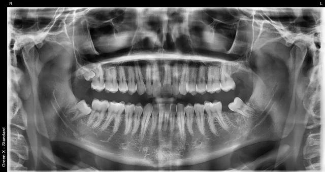rtg zęba do leczenia kanałowego łódź