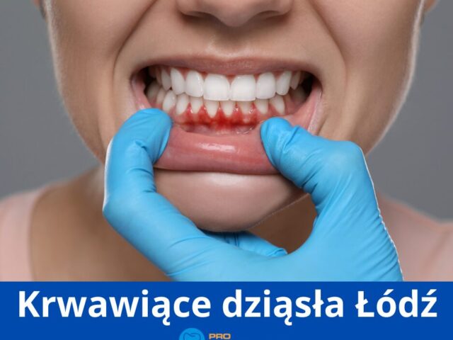 Krwawiące dziąsła Łódź – przyczyny i skuteczne leczenie | Pro EndoDentica