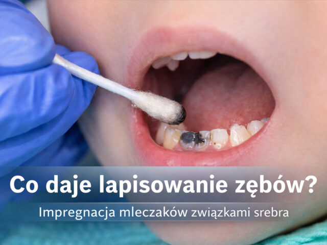 Co daje lapisowanie zębów? Efekty, wskazania i czarne przebarwienia | Pro EndoDentica